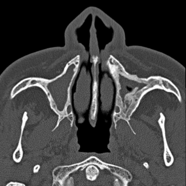 Chronic maxillary sinusitis (Radiopaedia 27879-28116 Axial bone window 10).jpg