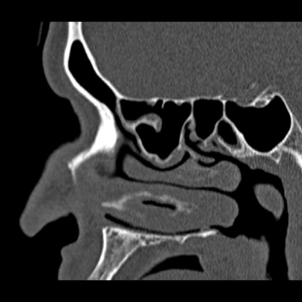 Chronic maxillary sinusitis (Radiopaedia 27879-28116 Sagittal bone window 21).jpg
