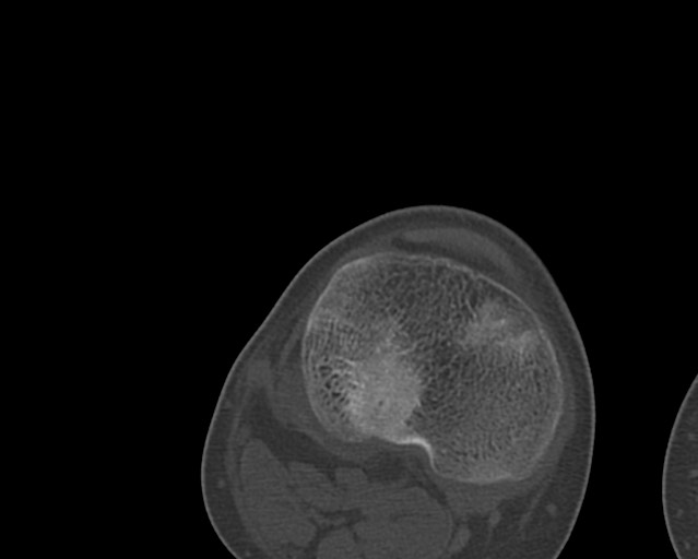 Chronic ostemyelitis of the femur with long sinus tract (Radiopaedia 74947-85982 Axial bone window 236).jpg