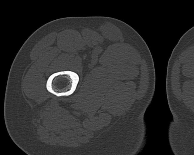 File:Chronic ostemyelitis of the femur with long sinus tract (Radiopaedia 74947-85982 Axial bone window 38).jpg