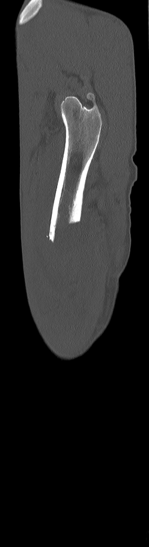 Chronic osteomyelitis (with sequestrum) (Radiopaedia 74813-85822 C 97).jpg