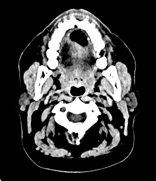 File:Chronic osteomyelitis - calvarial (severe) (Radiopaedia 69668-79616 Axial non-contrast 14).jpg