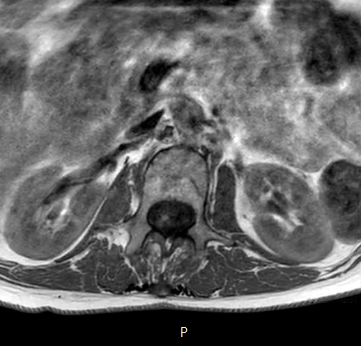 File:Chronic spinal hematoma with cauda equina syndrome (Radiopaedia 75745-87090 Axial T1 3).png