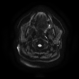 Chronic submandibular sialadenitis (Radiopaedia 61852-69885 Axial DWI 9).jpg