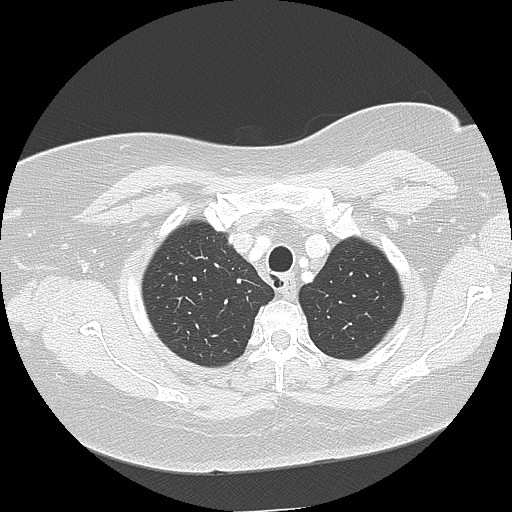 Cicatrisation collapse (Radiopaedia 17405-17089 lung window 19).jpg