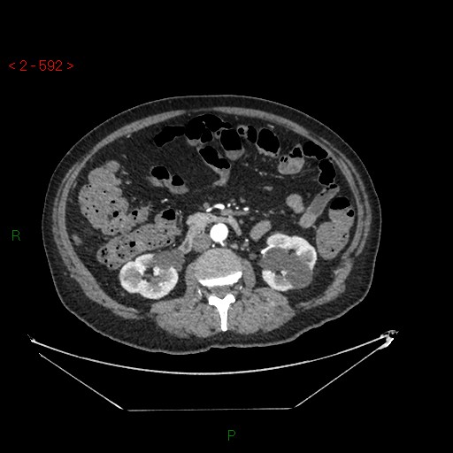 Circumaortic left renal vein and doubled left renal arteries (Radiopaedia 52268-58158 A 128).jpg
