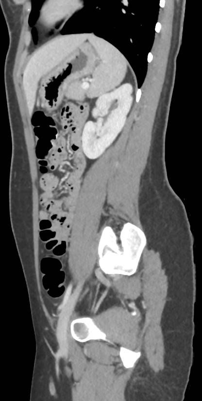 Circumaortic left renal vein with a duplicated retroaortic vein (Radiopaedia 91668-109398 C 87).jpg