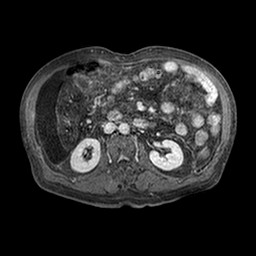 Cirrhosis and hepatocellular carcinoma in the setting of hemochromatosis (Radiopaedia 75394-86594 Axial T1 C+ fat sat 276).jpg