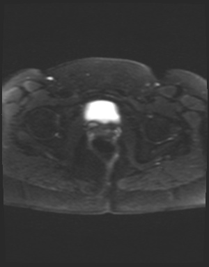 Class II Mullerian duct anomaly- unicornuate uterus with rudimentary horn and non-communicating cavity (Radiopaedia 39441-41755 Axial DWI 23).jpg