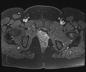 File:Class II Mullerian duct anomaly- unicornuate uterus with rudimentary horn and non-communicating cavity (Radiopaedia 39441-41755 Axial T1 fat sat 126).jpg