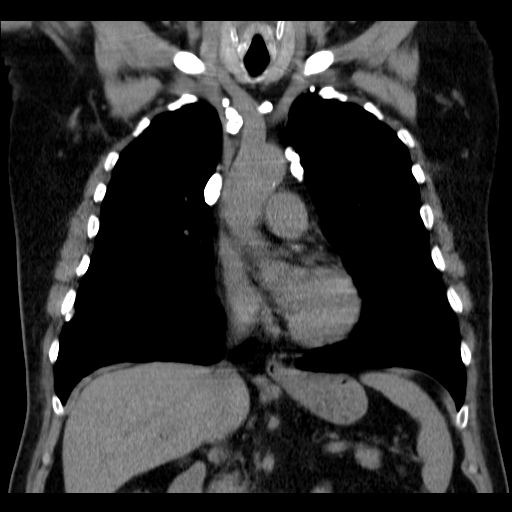 File:Classic complicated silicosis (Radiopaedia 49720-54961 Coronal liver window 25).jpg