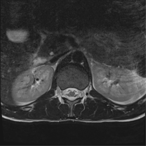 File:Clear cell meningoma - lumbar spine (Radiopaedia 60116-67690 Axial T2 42).png