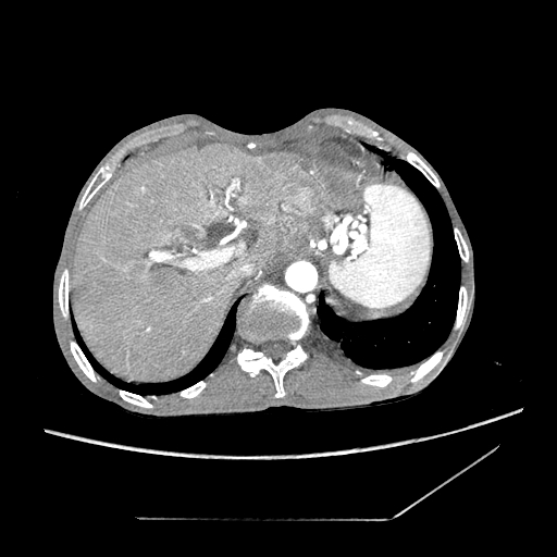 Closed-loop obstruction due to peritoneal seeding mimicking internal hernia after total gastrectomy (Radiopaedia 81897-95864 A 12).jpg