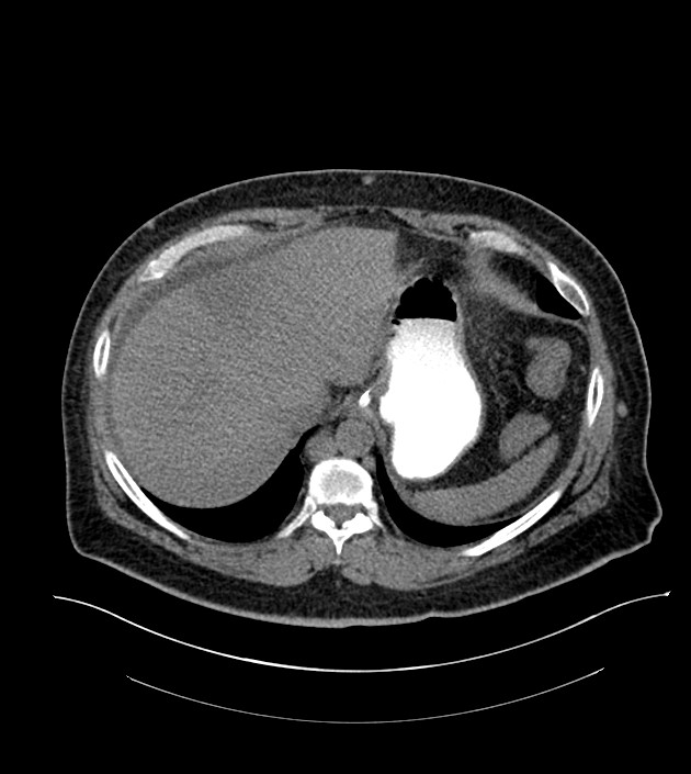 Closed-loop small bowel obstruction-internal hernia (Radiopaedia 78439-91096 Axial non-contrast 26).jpg