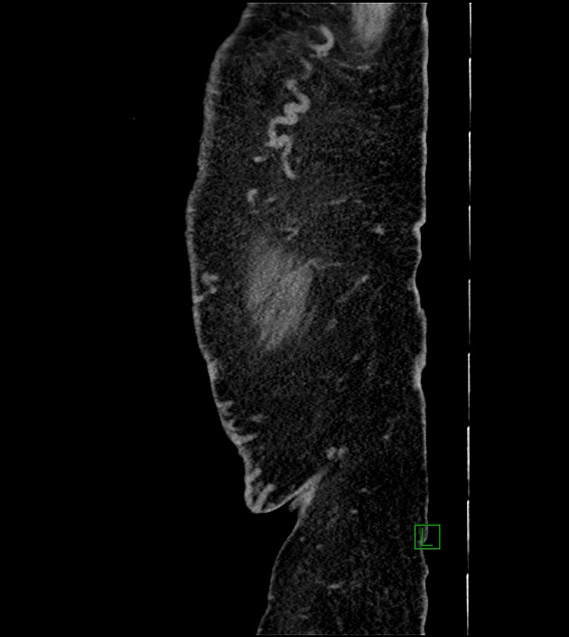 Closed-loop small bowel obstruction-internal hernia (Radiopaedia 78439-91096 C 12).jpg