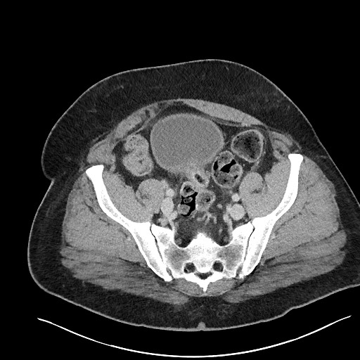 File:Closed loop obstruction - internal hernia into nephrectomy bed (Radiopaedia 59867-67320 A 113).jpg