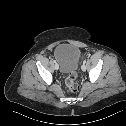 File:Closed loop obstruction - internal hernia into nephrectomy bed (Radiopaedia 59867-67320 Axial 106).jpg