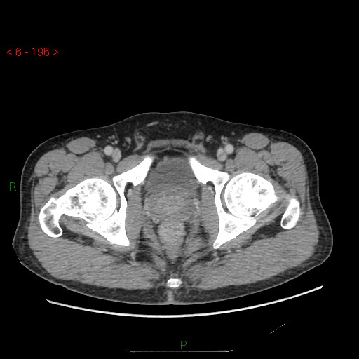File:Closed loop obstruction and appendicular stump mucocele (Radiopaedia 54014-60163 A 118).jpg