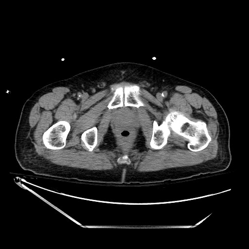 File:Closed loop obstruction due to adhesive band, resulting in small bowel ischemia and resection (Radiopaedia 83835-99023 Axial non-contrast 157).jpg