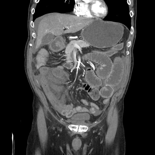 Closed loop obstruction due to adhesive band, resulting in small bowel ischemia and resection (Radiopaedia 83835-99023 C 47).jpg
