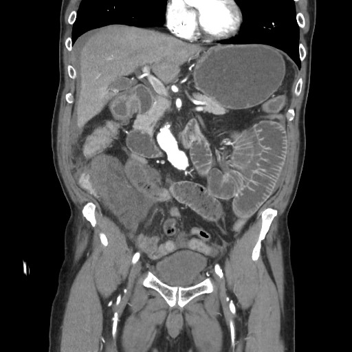 File:Closed loop obstruction due to adhesive band, resulting in small bowel ischemia and resection (Radiopaedia 83835-99023 C 55).jpg