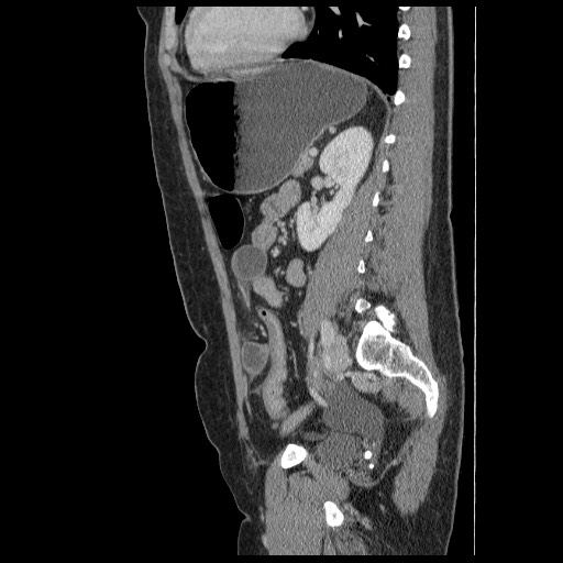 File:Closed loop small bowel obstruction (Radiopaedia 65403-74451 C 68).jpg