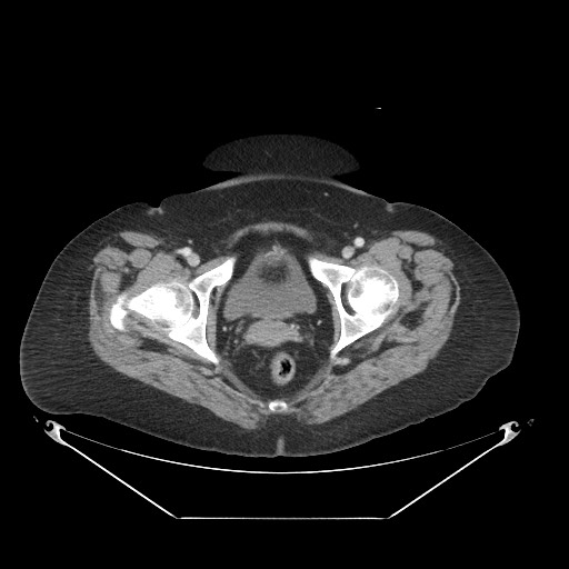 Closed loop small bowel obstruction - internal hernia (Radiopaedia 65402-74450 A 128).jpg