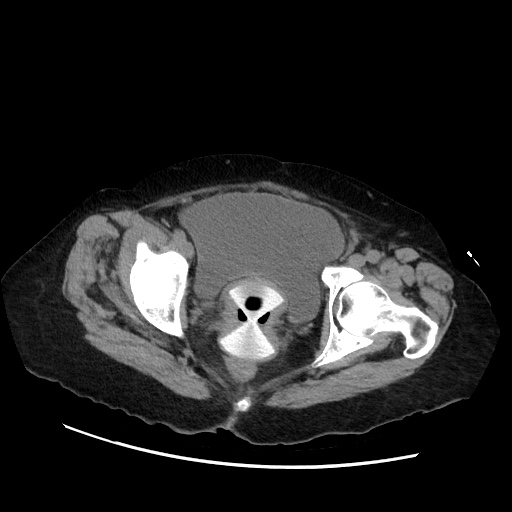 Closed loop small bowel obstruction due to adhesive band, with intramural hemorrhage and ischemia (Radiopaedia 83831-99017 Axial non-contrast 146).jpg