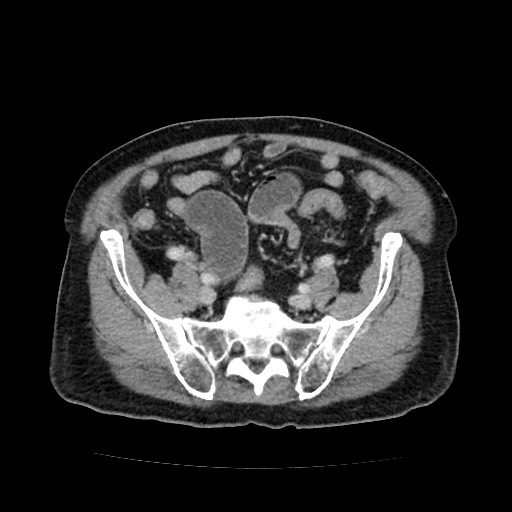 File:Closed loop small bowel obstruction due to adhesive band - U-shaped loop (Radiopaedia 83829-99012 A 50).jpg