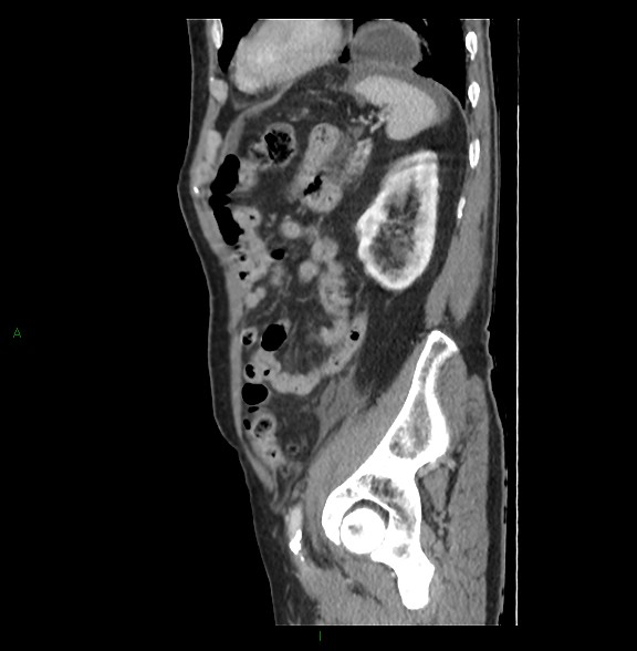 Closed loop small bowel obstruction with ischemia (Radiopaedia 84180-99456 C 69).jpg