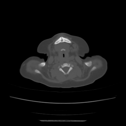 Cloverleaf skull (Radiopaedia 91901-109710 Axial bone window 17).jpg