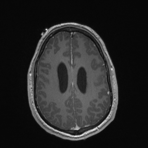 File:Colloid cyst (Radiopaedia 44510-48181 Axial T1 C+ 133).png