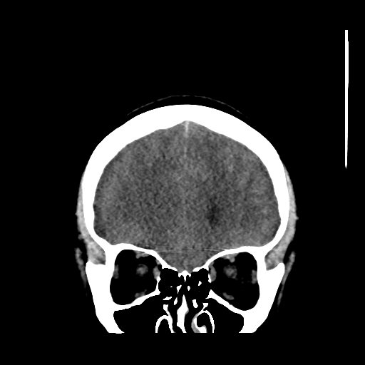 Colloid cyst (resulting in death) (Radiopaedia 33423-34469 Coronal non-contrast 12).png