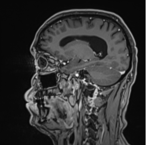 File:Colloid cyst of the third ventricle (Radiopaedia 86571-102662 Sagittal T1 C+ 51).png