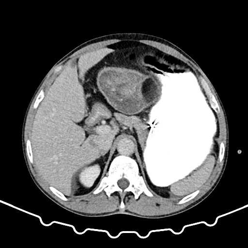 File:Colocolic intussusception due to large lipoma (Radiopaedia 68773-78482 A 41).jpg