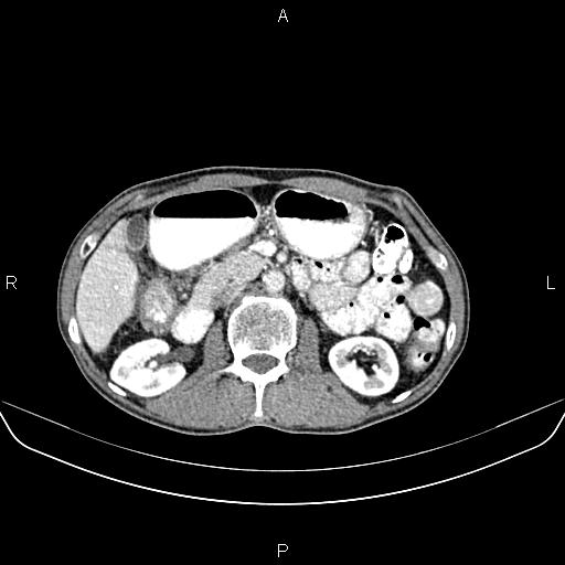 File:Colon adenocarcinoma - hepatic flexure (Radiopaedia 85635-101395 A 35).jpg
