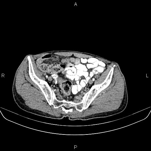 Colon adenocarcinoma - hepatic flexure (Radiopaedia 85635-101395 A 78).jpg