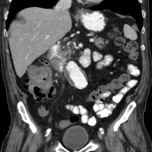 File:Colon cancer with duodenal invasion (Radiopaedia 16278-15958 B 29).jpg