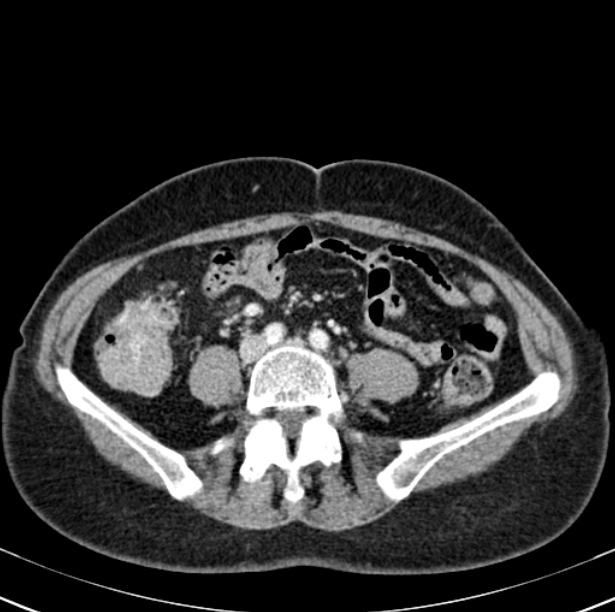 Colon carcinoma with hepatic metastases (Radiopaedia 29477-29961 A 73).jpg