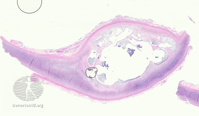 File:Figure 1 (DermNet NZ pathology-e-auricle-pseudocyst-figure-1).jpg