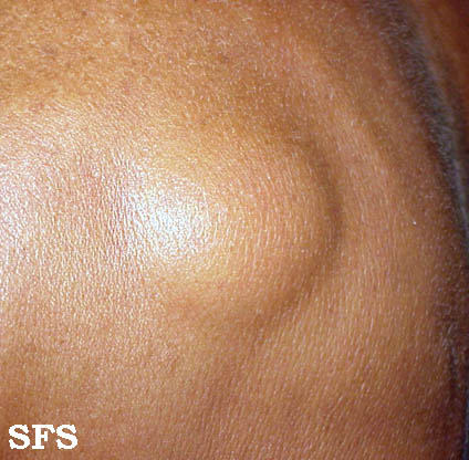 File:Lipoma (Dermatology Atlas 3).jpg