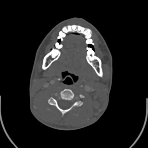 Nasopharyngeal carcinoma with skull base invasion (Radiopaedia 53415-59705 Axial bone window 111).jpg