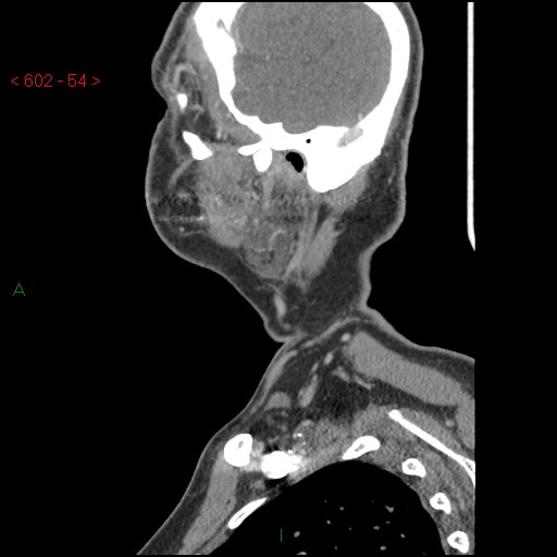 File:Nasopharyngeal lymphoma (Radiopaedia 54235-60433 B 1).jpg