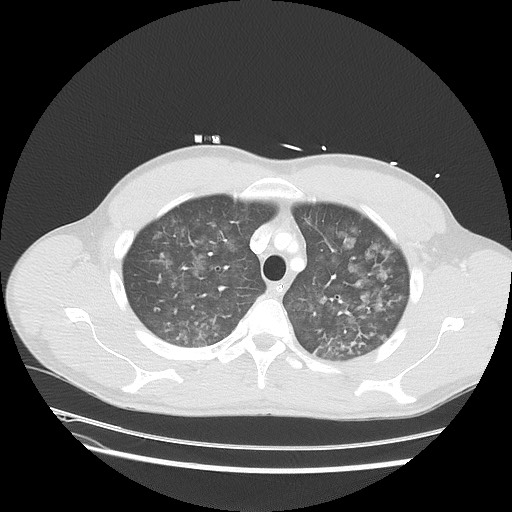 Near-drowning pulmonary edema (Radiopaedia 59457-66814 Axial lung window 14).jpg