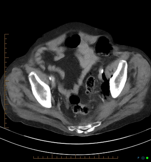 Necrotzing fasciitis due to a perforated adenocarcinoma of the splenic flexure (Radiopaedia 46930-51455 A 54).jpg
