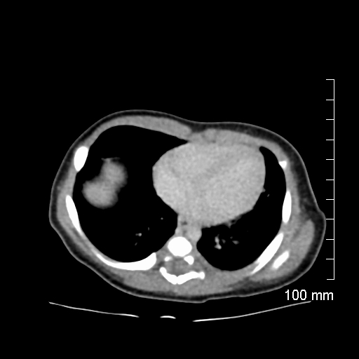 File:Neonatal neuroblastoma (Radiopaedia 56651-63438 Axial non-contrast 8).jpg
