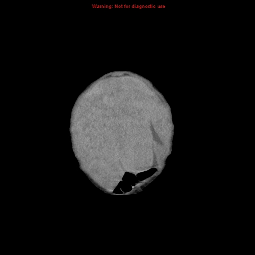 File:Neonatal neuroblastoma (Radiopaedia 9564-10223 B 14).jpg
