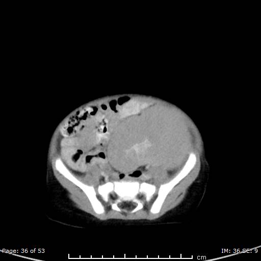 Nephroblastomatosis (Radiopaedia 41934-44935 A 36).jpg