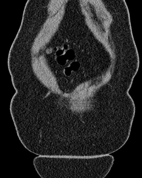 File:Nephrostomy for urosepsis (Radiopaedia 26180-26330 non-contrast 12).jpg