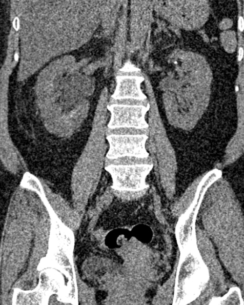 File:Nephrostomy for urosepsis (Radiopaedia 26180-26330 non-contrast 55).jpg